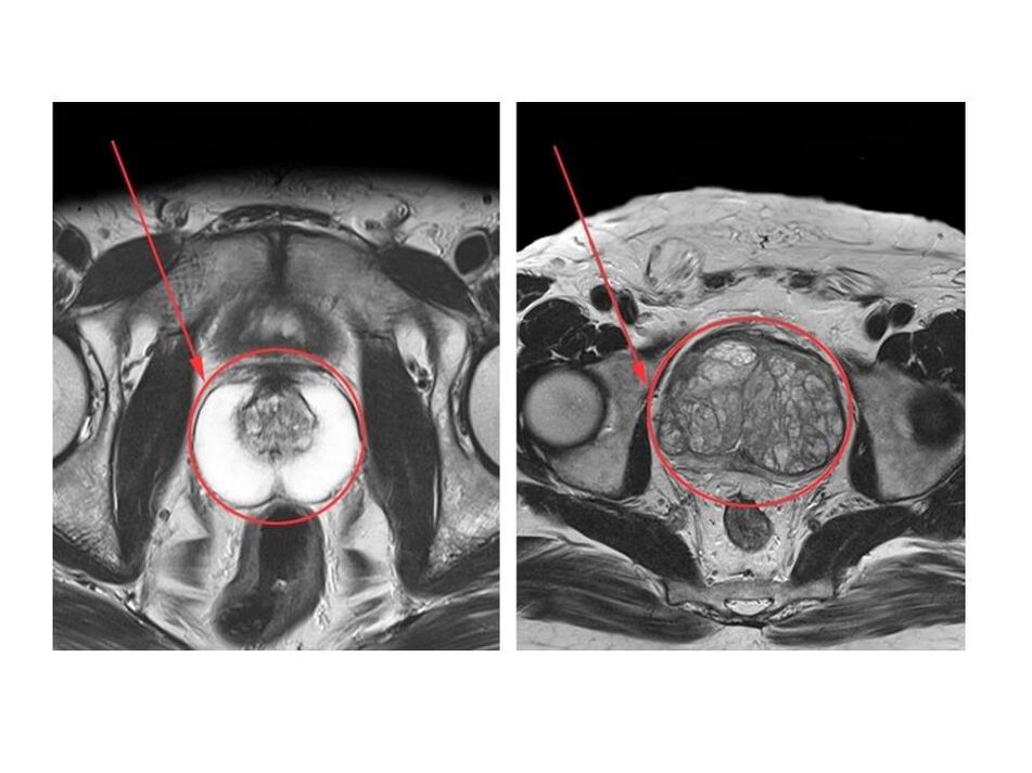 Primerjava zdrave (levo) in vnete (desno) prostate na MRI slikah